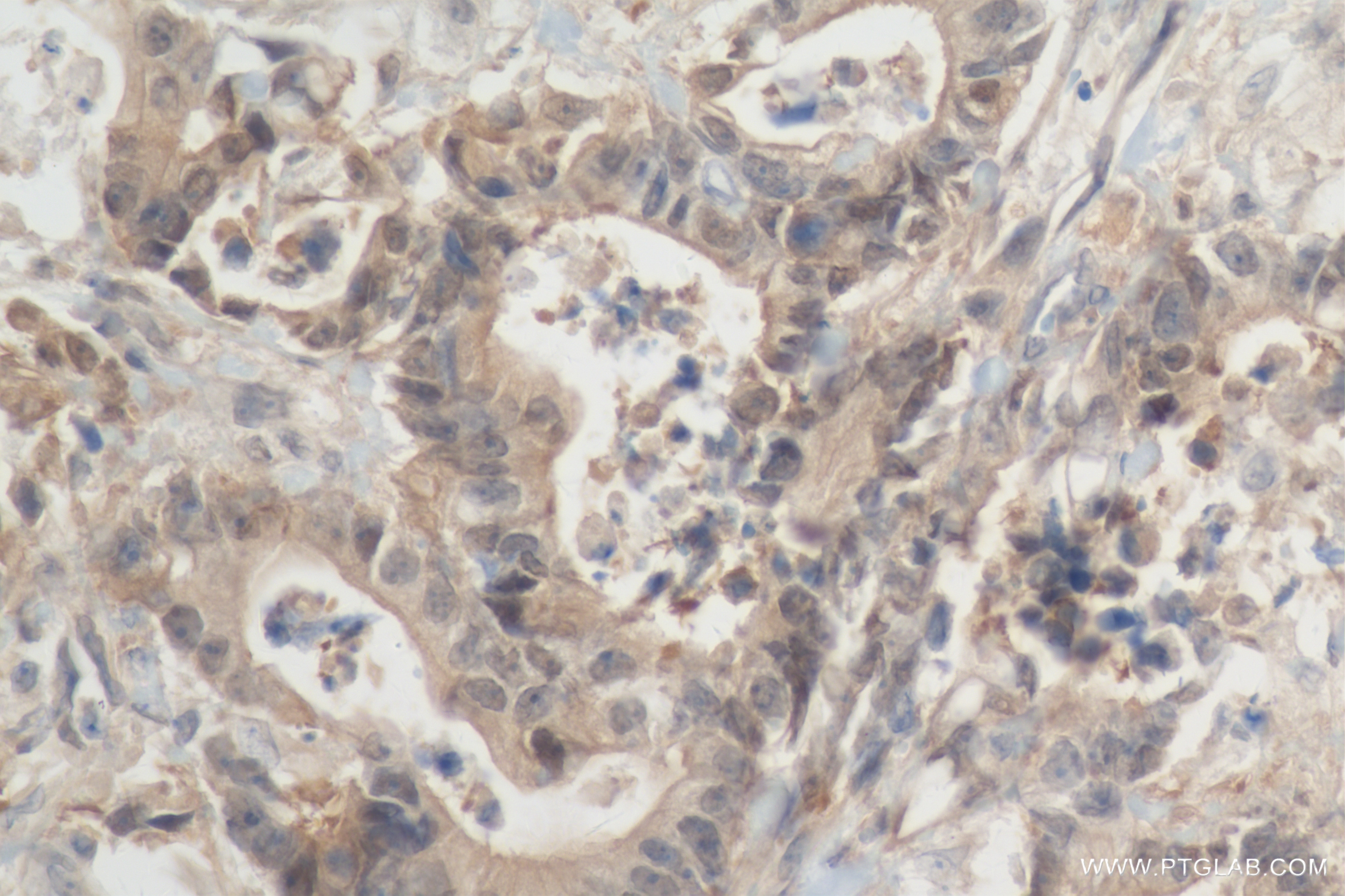 Immunohistochemistry (IHC) staining of human rectal cancer tissue using MGEA5 Recombinant antibody (84722-4-RR)