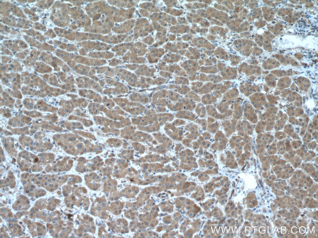 IHC staining of human liver cancer using 14986-1-PBS