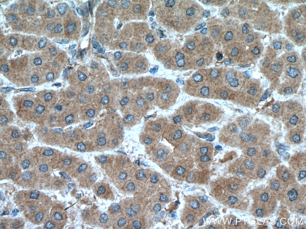 Immunohistochemistry (IHC) staining of human liver cancer tissue using MGLL Polyclonal antibody (14986-1-PBS)