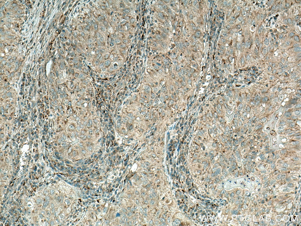Immunohistochemistry (IHC) staining of human lung cancer tissue using MGME1 Monoclonal antibody (67468-1-Ig)