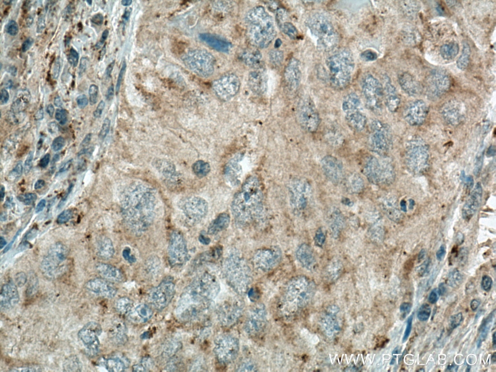 Immunohistochemistry (IHC) staining of human lung cancer tissue using MGME1 Monoclonal antibody (67468-1-Ig)