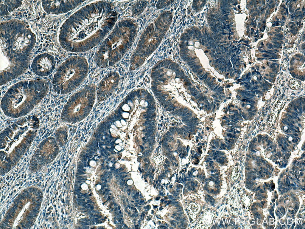 Immunohistochemistry (IHC) staining of human colon cancer tissue using MGME1 Monoclonal antibody (67468-1-Ig)