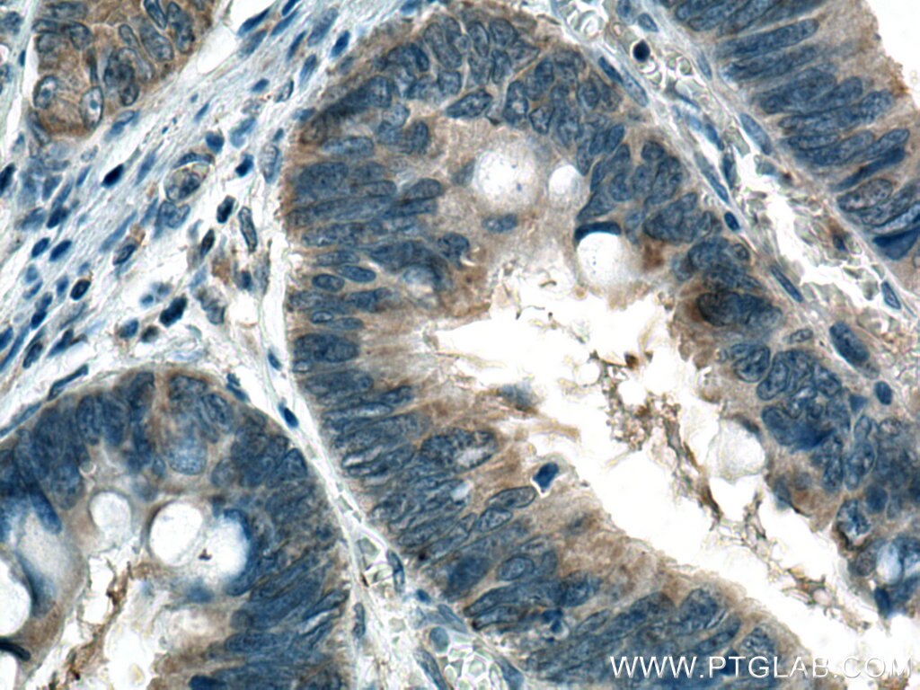 Immunohistochemistry (IHC) staining of human colon cancer tissue using MGME1 Monoclonal antibody (67468-1-Ig)