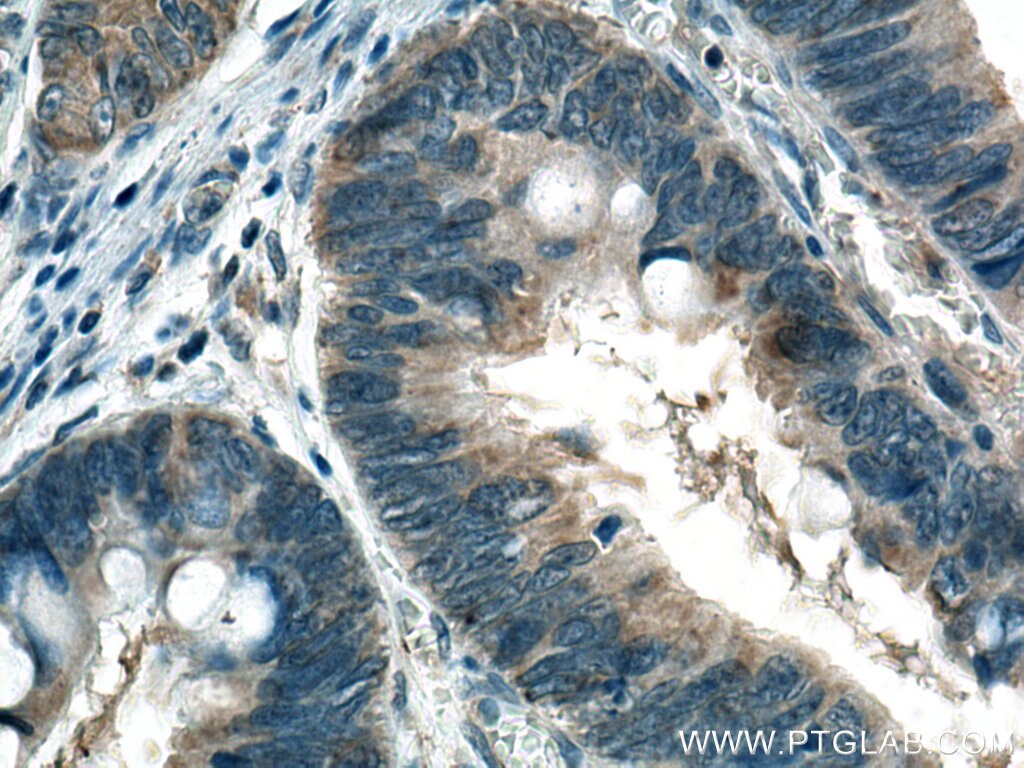 IHC staining of human colon cancer using 67468-1-Ig