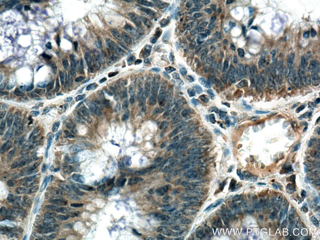 Immunohistochemistry (IHC) staining of human colon cancer tissue using MGME1 Monoclonal antibody (67468-1-Ig)