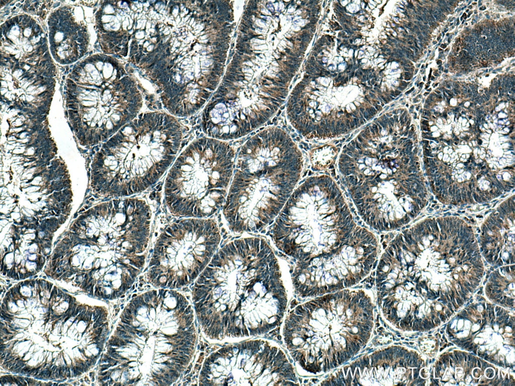 Immunohistochemistry (IHC) staining of human colon cancer tissue using MGME1 Monoclonal antibody (67468-1-Ig)