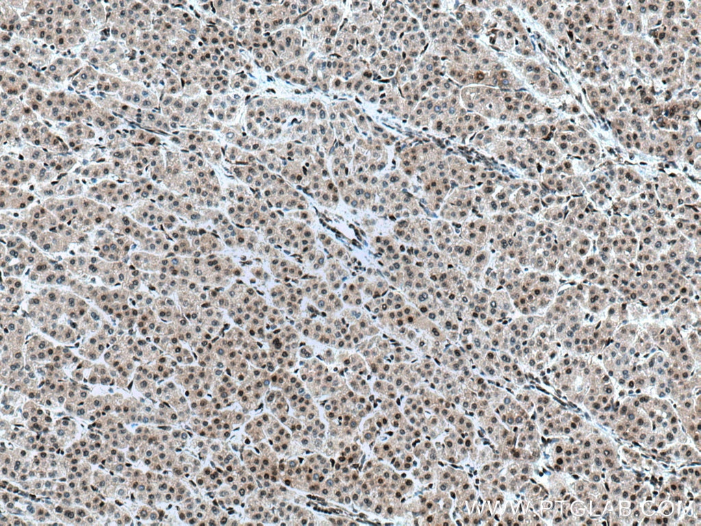 Immunohistochemistry (IHC) staining of human liver cancer tissue using MGMT Polyclonal antibody (17195-1-AP)