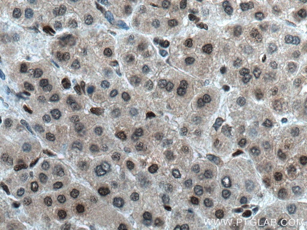 Immunohistochemistry (IHC) staining of human liver cancer tissue using MGMT Polyclonal antibody (17195-1-AP)