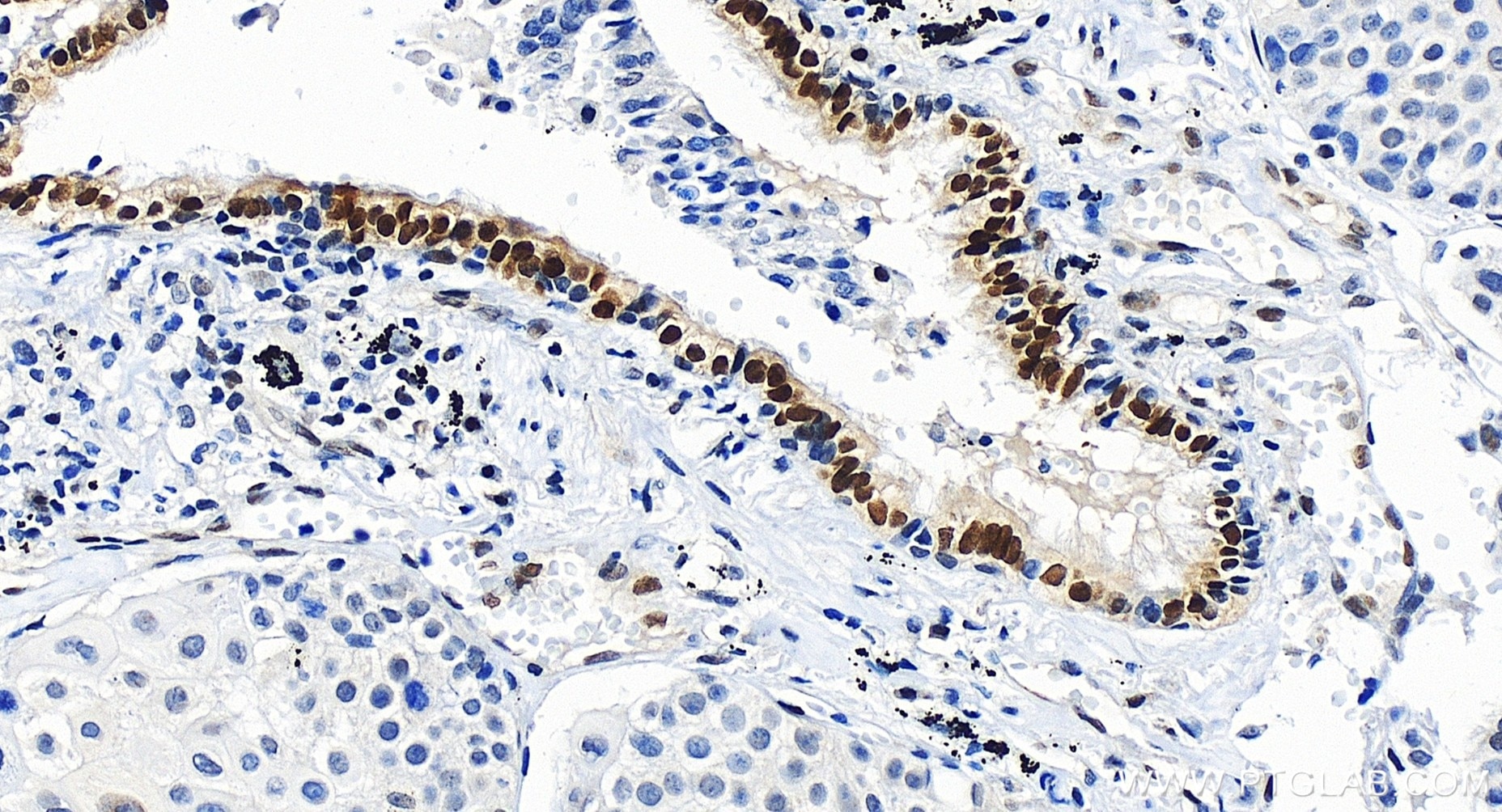 Immunohistochemistry (IHC) staining of human lung cancer tissue using MGMT Recombinant antibody (86115-5-RR)
