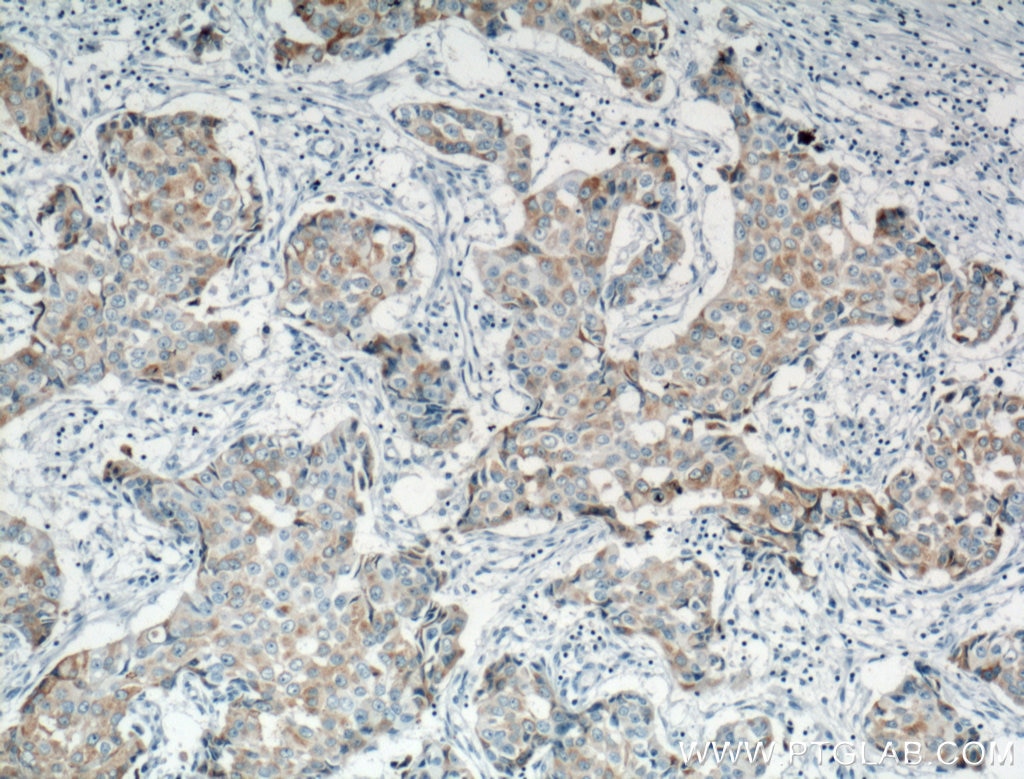 Immunohistochemistry (IHC) staining of human breast cancer tissue using MGP Polyclonal antibody (10734-1-AP)