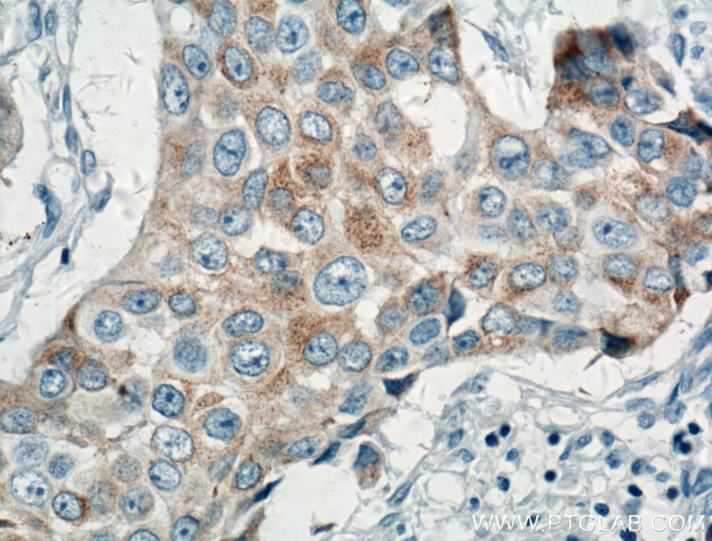 Immunohistochemistry (IHC) staining of human breast cancer tissue using MGP Polyclonal antibody (10734-1-AP)