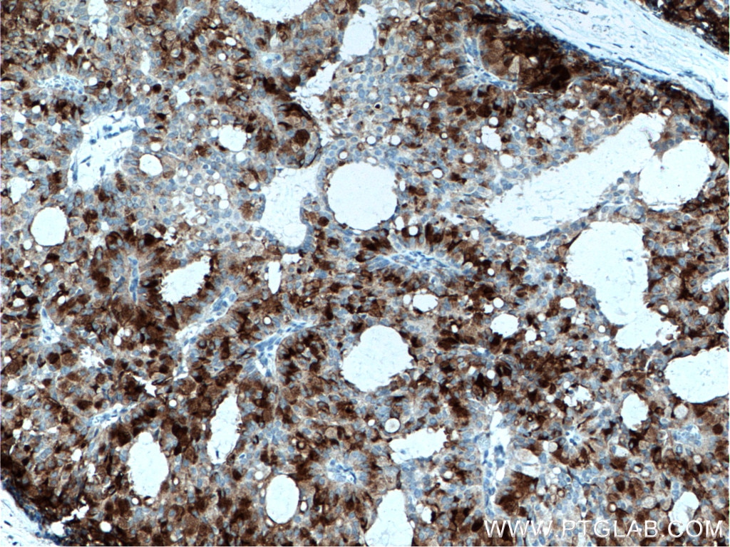 Immunohistochemistry (IHC) staining of human breast hyperplasia tissue using MGP Polyclonal antibody (10734-1-AP)