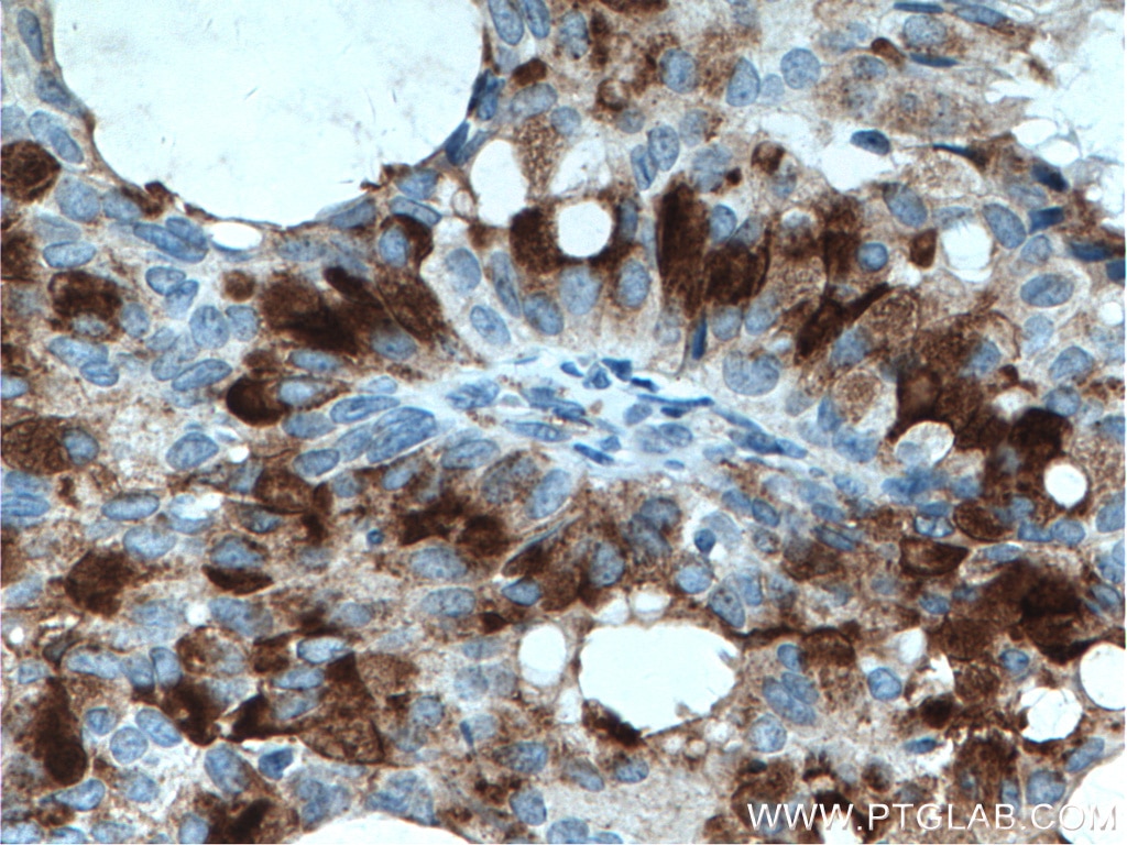 Immunohistochemistry (IHC) staining of human breast hyperplasia tissue using MGP Polyclonal antibody (10734-1-AP)