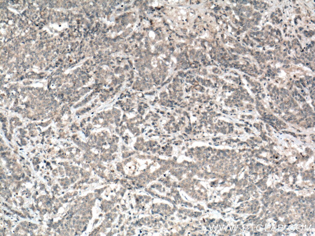 Immunohistochemistry (IHC) staining of human colon cancer tissue using MGP Polyclonal antibody (10734-1-AP)