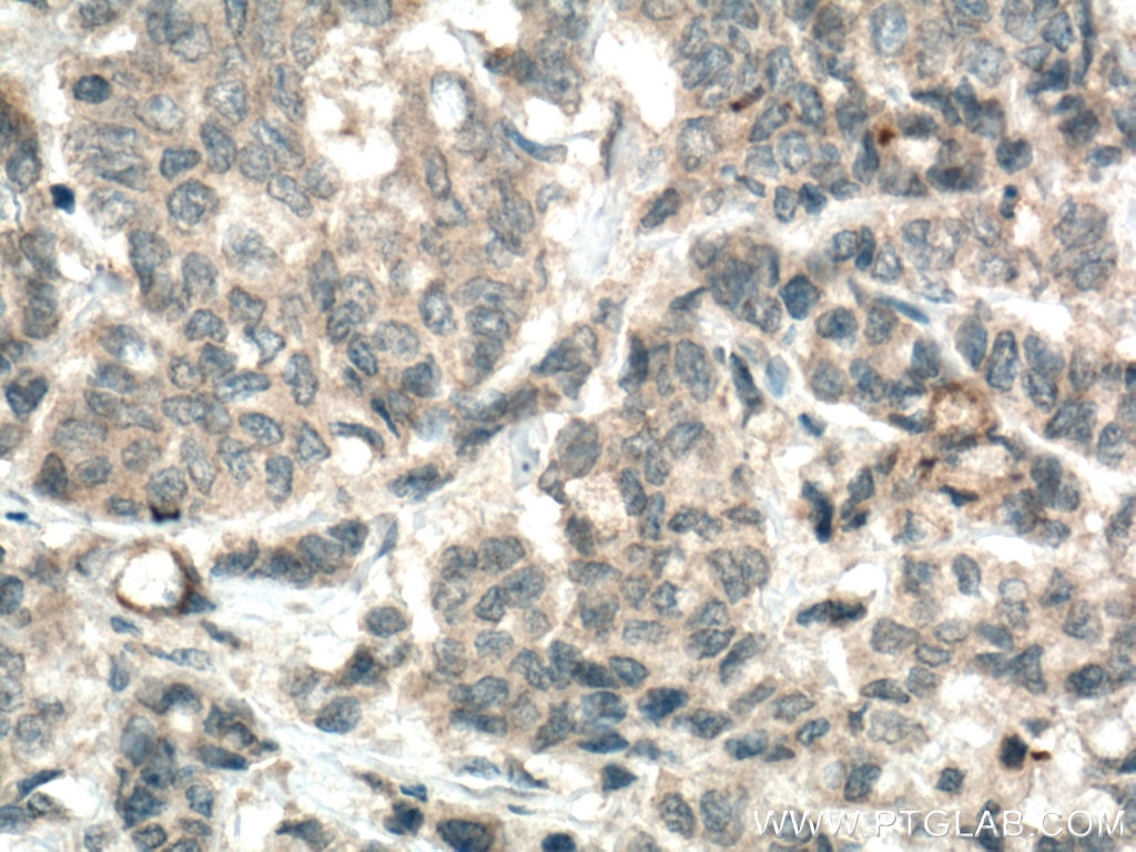 Immunohistochemistry (IHC) staining of human colon cancer tissue using MGP Polyclonal antibody (10734-1-AP)