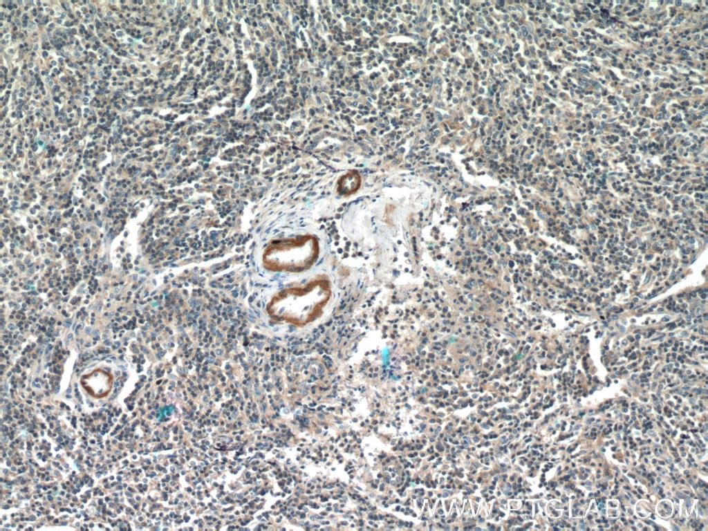 Immunohistochemistry (IHC) staining of human lymphoma tissue using MGP Polyclonal antibody (10734-1-AP)