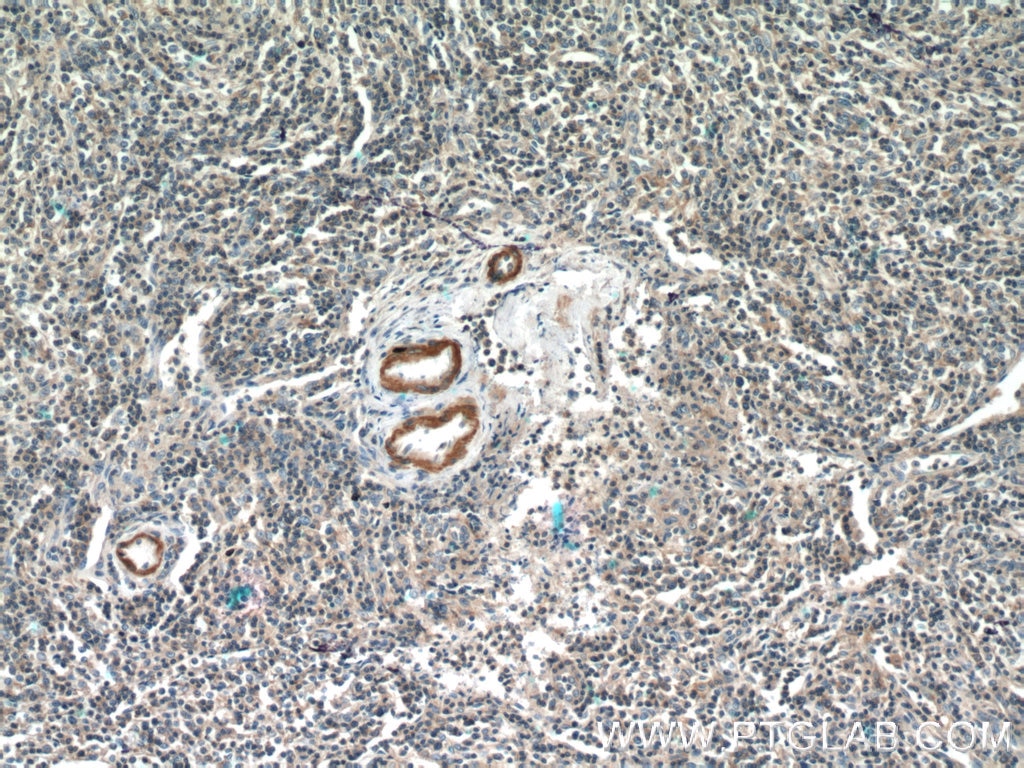 IHC staining of human lymphoma using 10734-1-AP