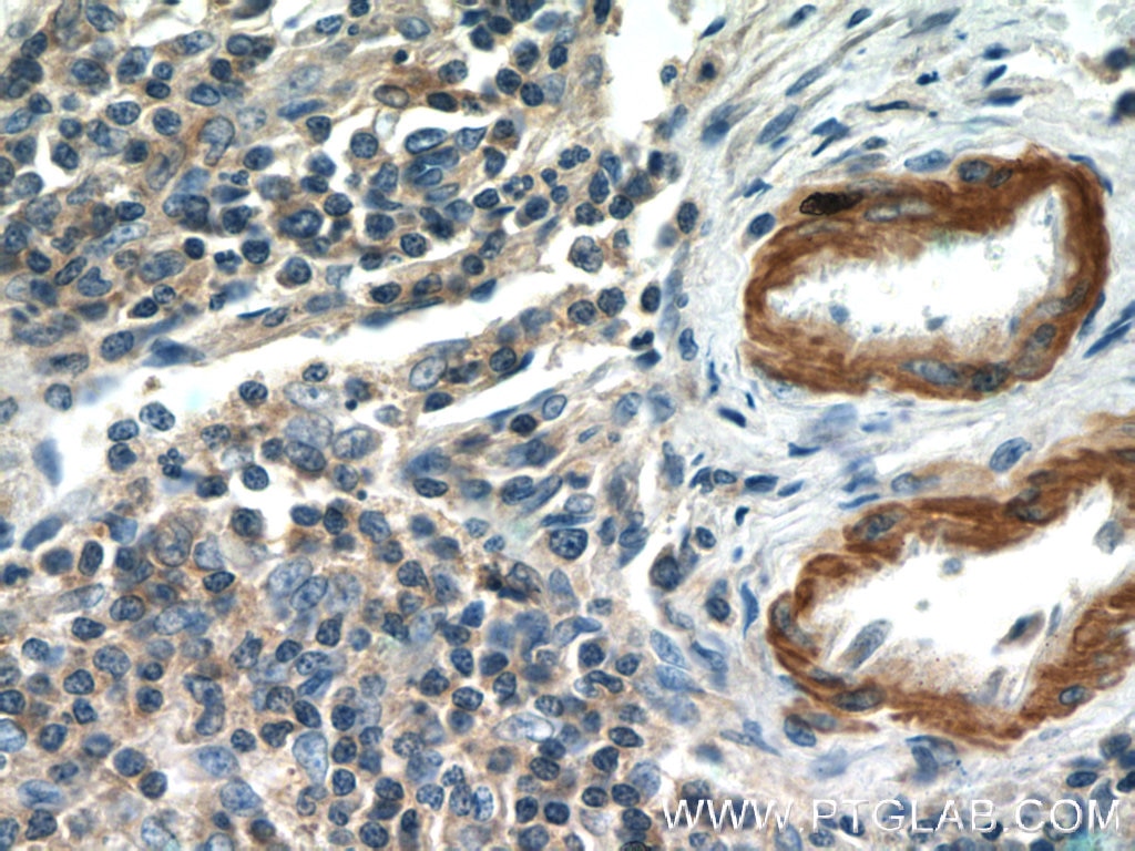 Immunohistochemistry (IHC) staining of human lymphoma tissue using MGP Polyclonal antibody (10734-1-AP)