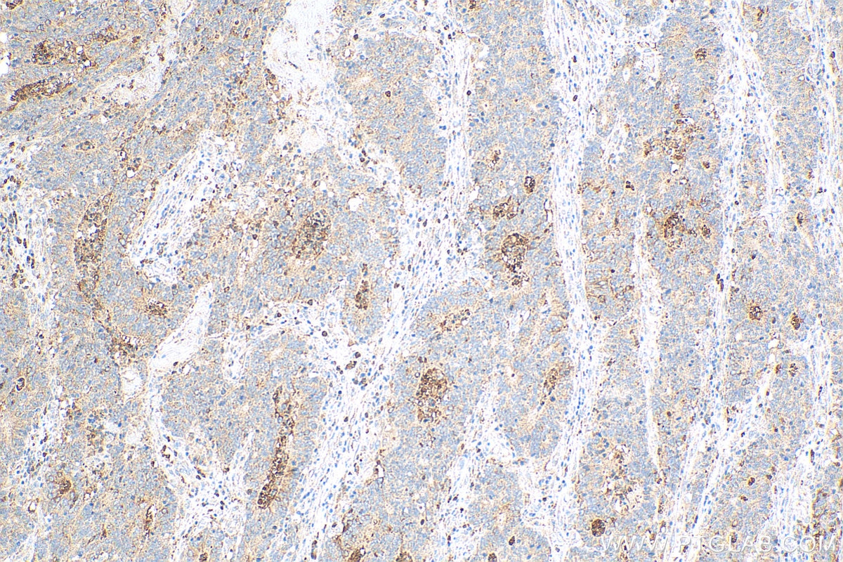 Immunohistochemistry (IHC) staining of human colon cancer tissue using MGP Polyclonal antibody (10734-1-AP)