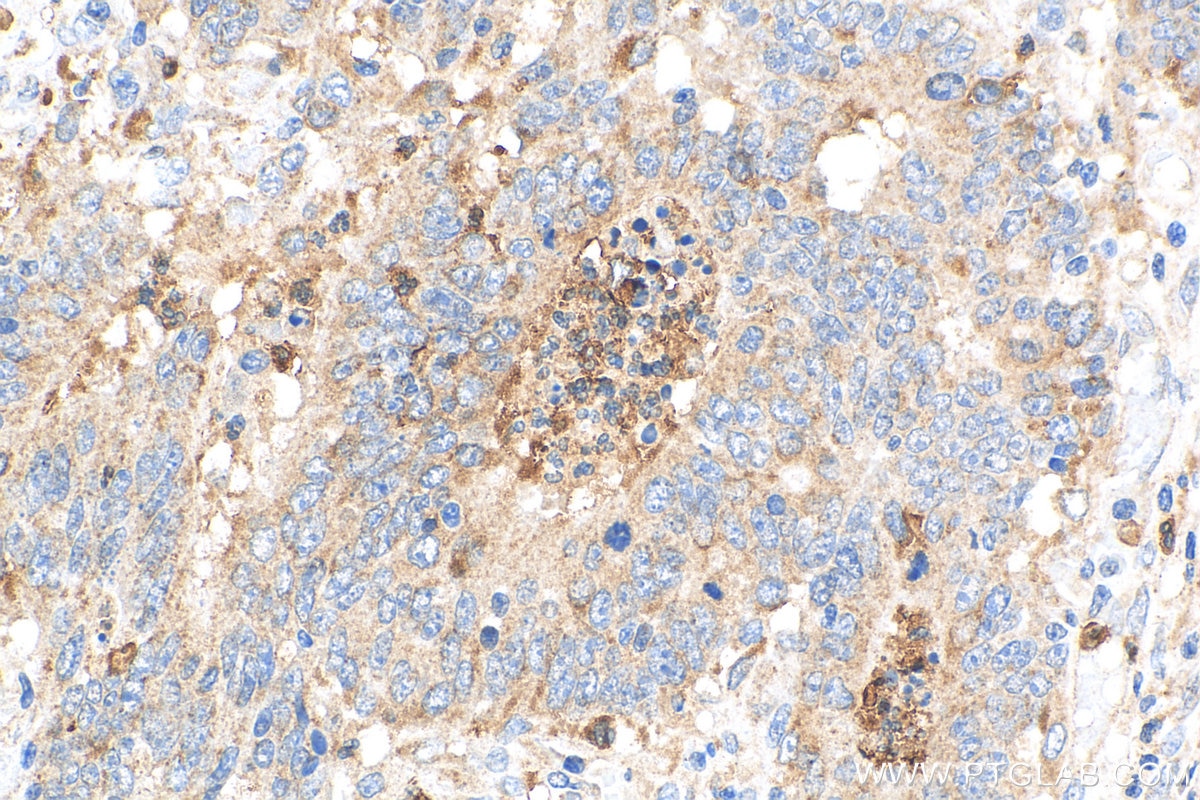 Immunohistochemistry (IHC) staining of human colon cancer tissue using MGP Polyclonal antibody (10734-1-AP)