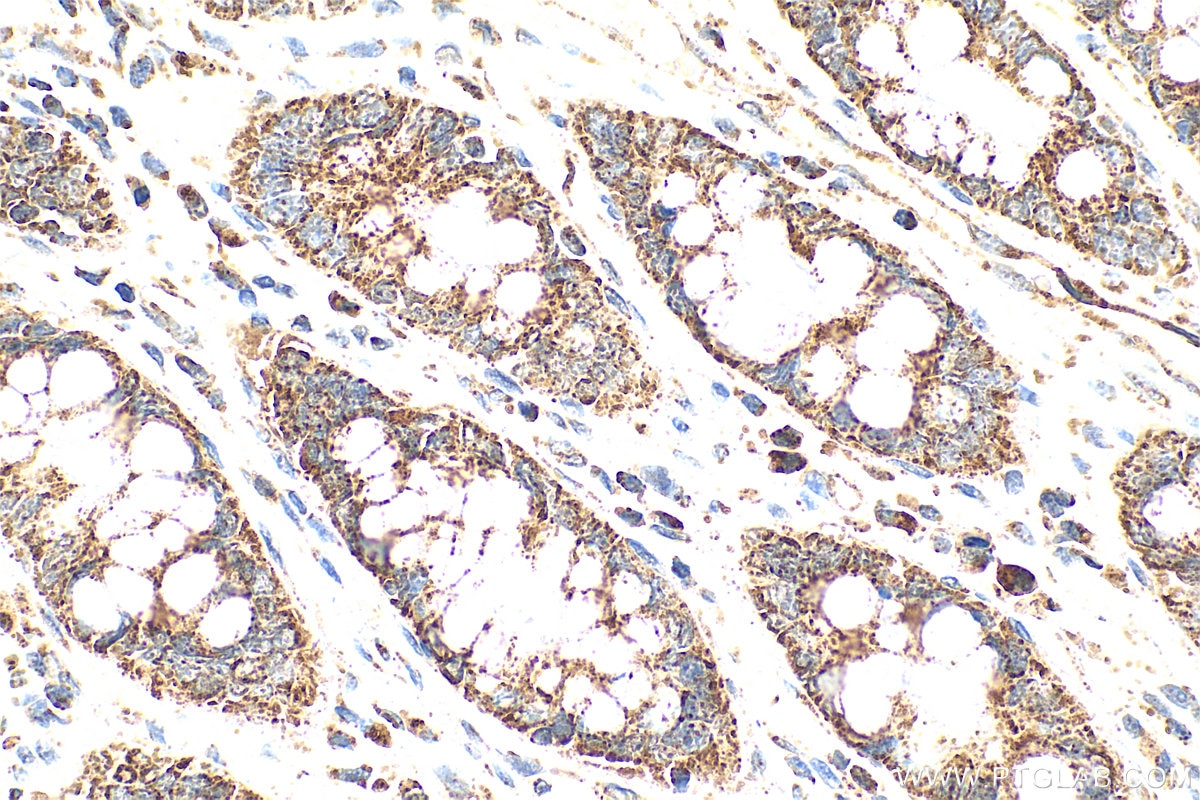 Immunohistochemistry (IHC) staining of human rectal cancer tissue using MGP Polyclonal antibody (10734-1-AP)