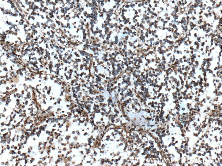 Immunohistochemistry (IHC) staining of human gliomas tissue using MGP Monoclonal antibody (60055-1-Ig)