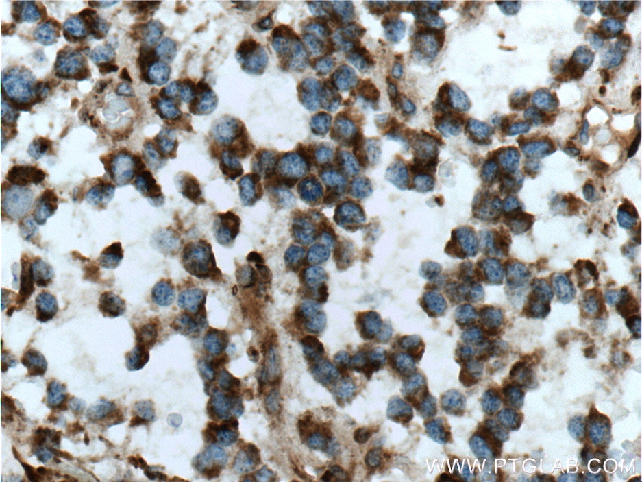 Immunohistochemistry (IHC) staining of human gliomas tissue using MGP Monoclonal antibody (60055-1-Ig)