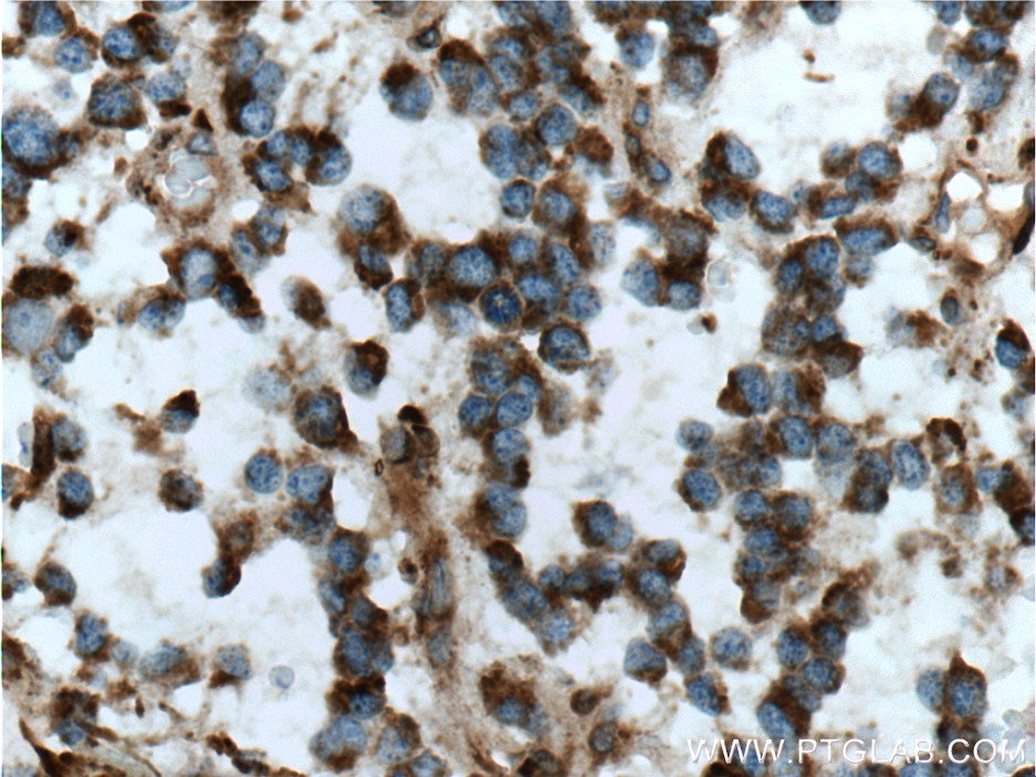 IHC staining of human gliomas using 60055-1-Ig