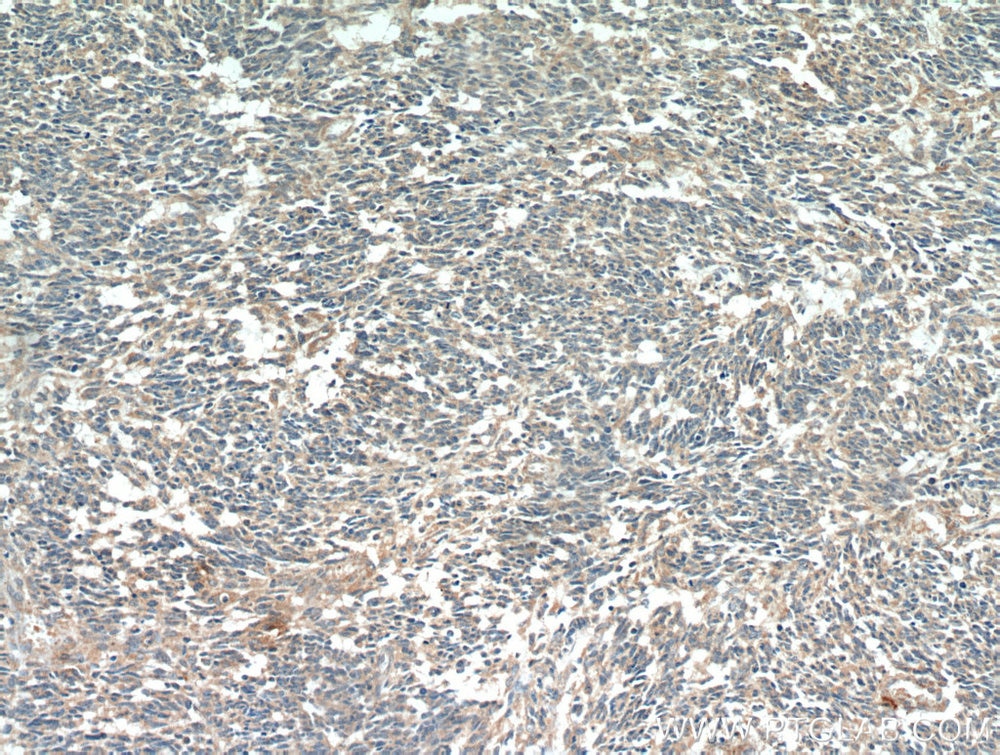 IHC staining of human gliomas using 60055-1-Ig