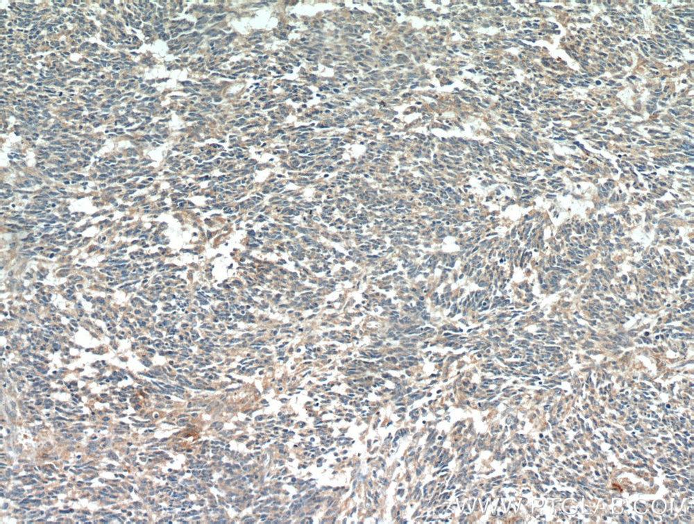 Immunohistochemistry (IHC) staining of human gliomas tissue using MGP Monoclonal antibody (60055-1-Ig)