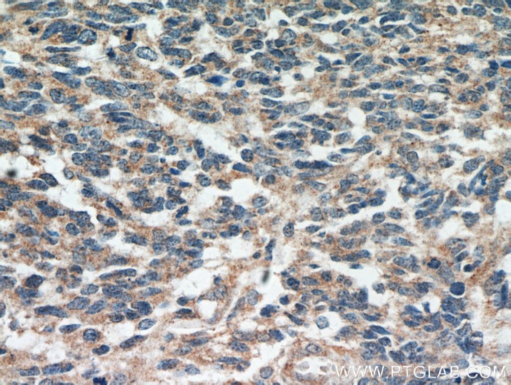 Immunohistochemistry (IHC) staining of human gliomas tissue using MGP Monoclonal antibody (60055-1-Ig)