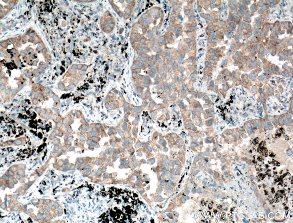 Immunohistochemistry (IHC) staining of human lung cancer tissue using RNF156 Polyclonal antibody (11285-1-AP)