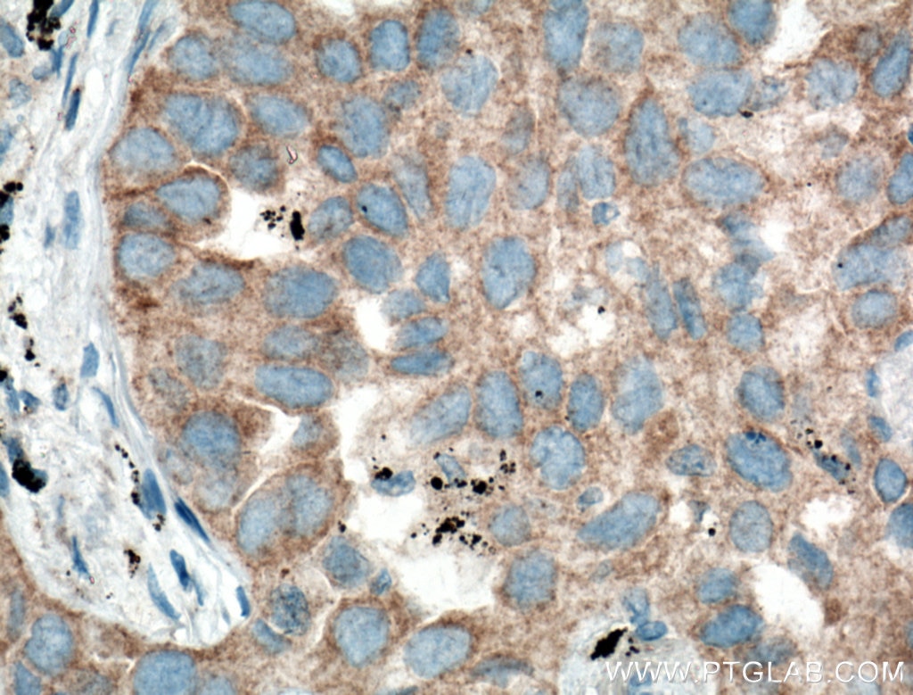 Immunohistochemistry (IHC) staining of human lung cancer tissue using RNF156 Polyclonal antibody (11285-1-AP)
