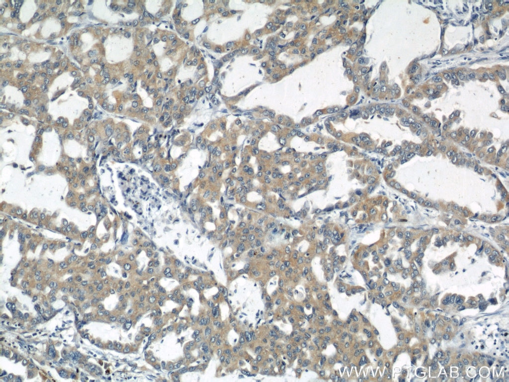 Immunohistochemistry (IHC) staining of human lung cancer tissue using RNF156 Polyclonal antibody (11285-1-AP)