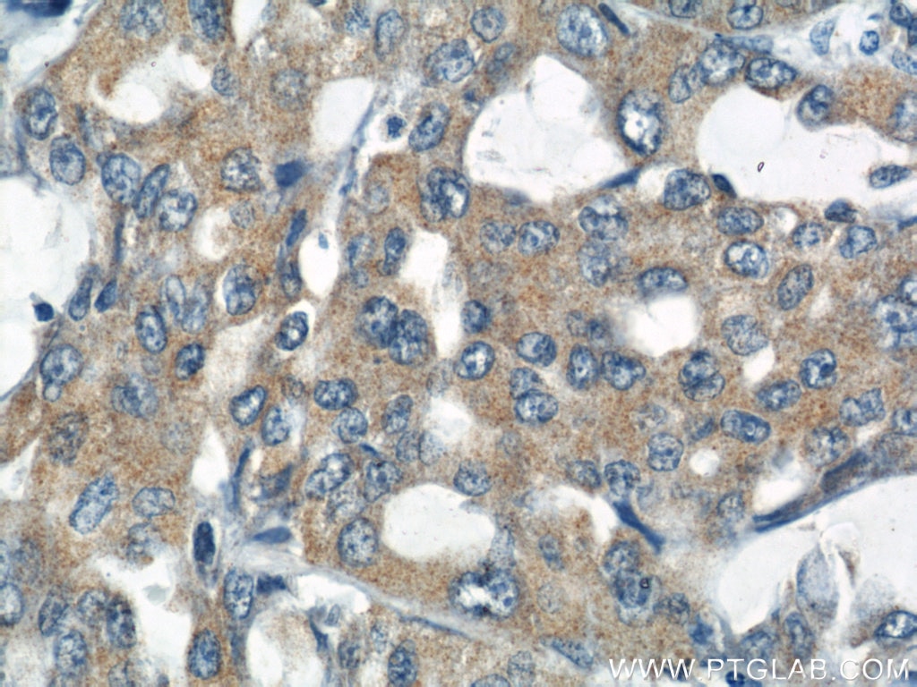 Immunohistochemistry (IHC) staining of human lung cancer tissue using RNF156 Polyclonal antibody (11285-1-AP)