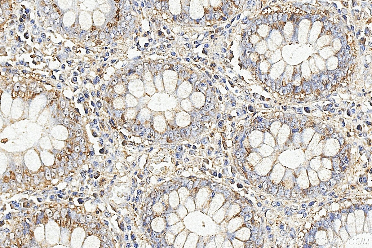 IHC staining of human colon using 25451-1-AP Immunohistochemistry (IHC) staining of human colon tissue using MGST2 Polyclonal antibody (25451-1-AP)