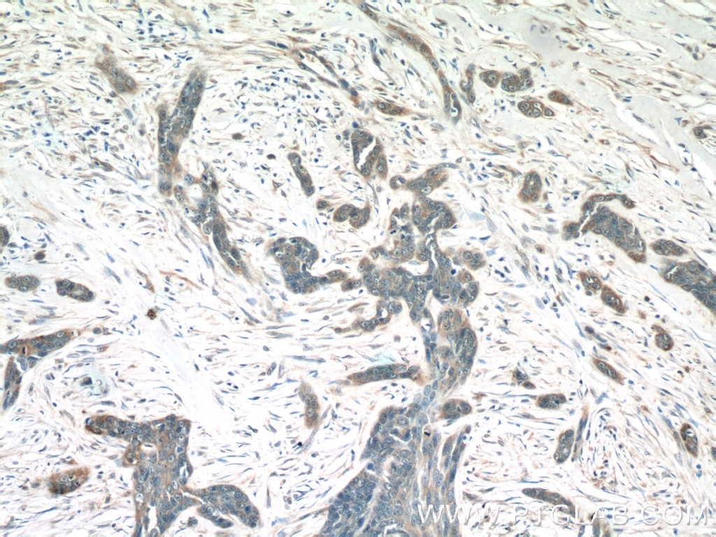 Immunohistochemistry (IHC) staining of human skin cancer tissue using MIA Polyclonal antibody (15734-1-AP)