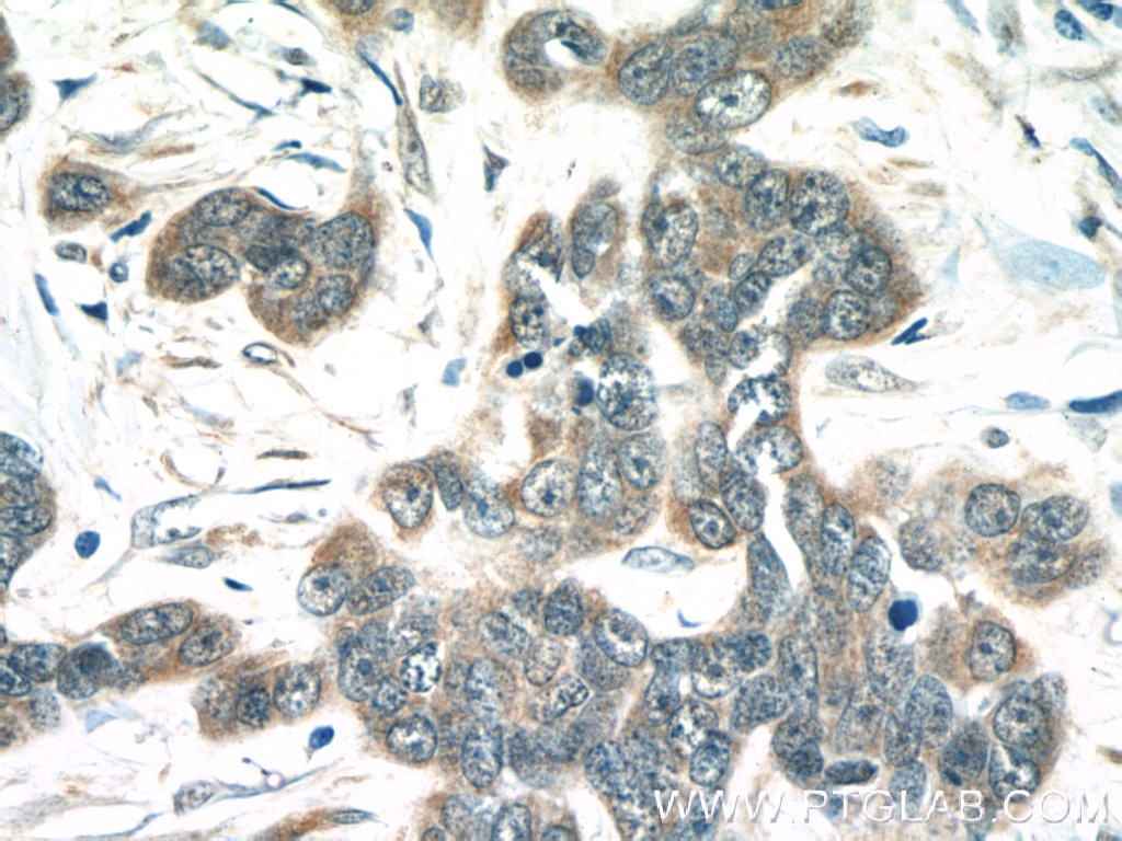 Immunohistochemistry (IHC) staining of human skin cancer tissue using MIA Polyclonal antibody (15734-1-AP)