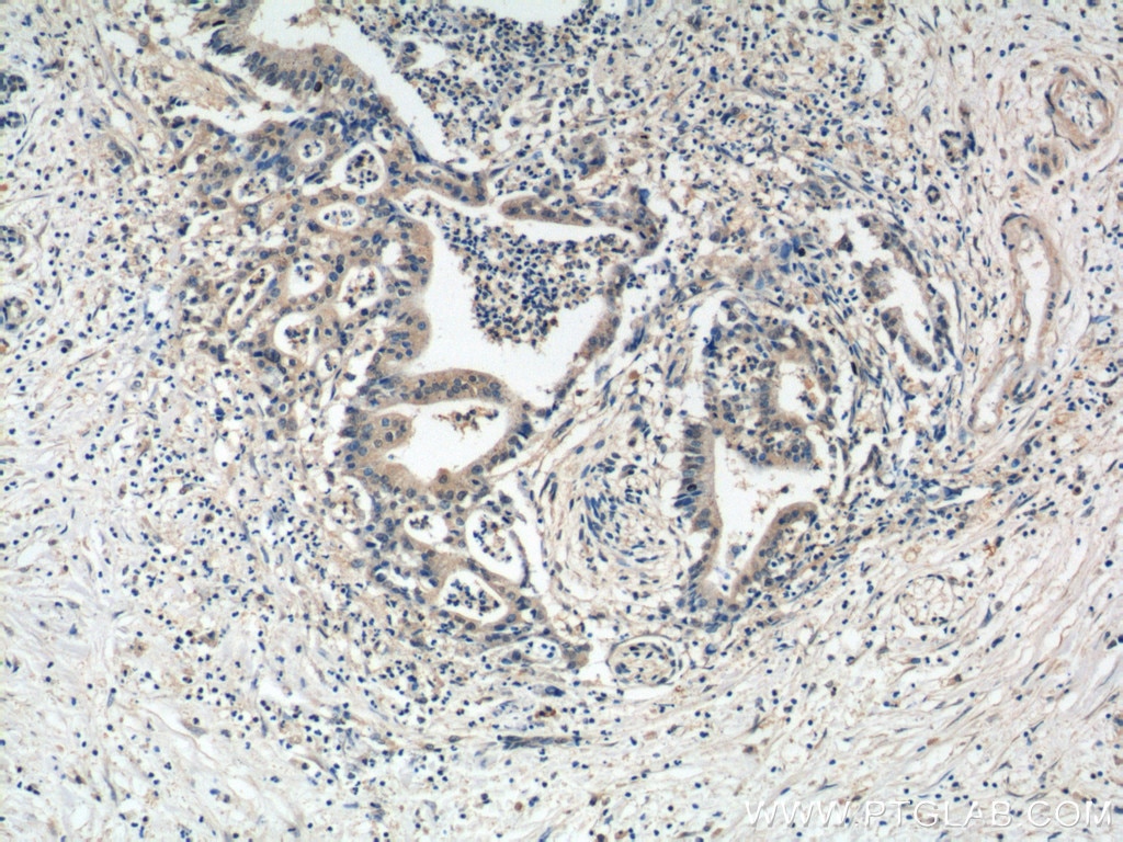 Immunohistochemistry (IHC) staining of human pancreas cancer tissue using MIA Polyclonal antibody (15734-1-AP)