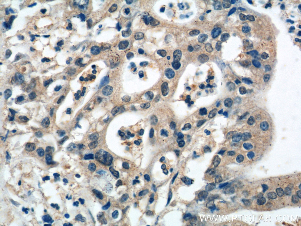 IHC staining of human pancreas cancer using 15734-1-AP