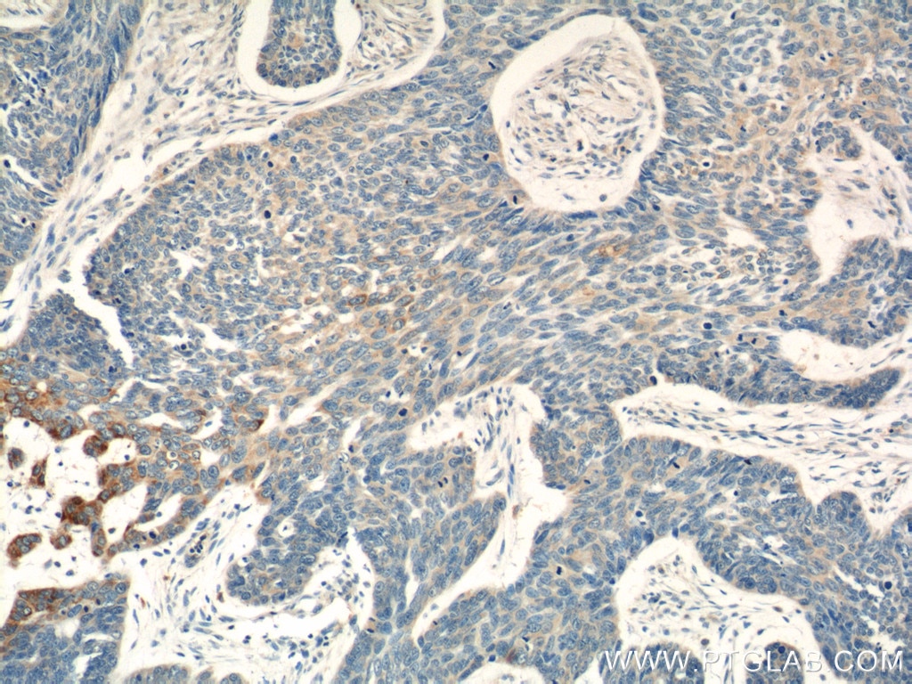 Immunohistochemistry (IHC) staining of human skin cancer tissue using MIA Polyclonal antibody (15734-1-AP)