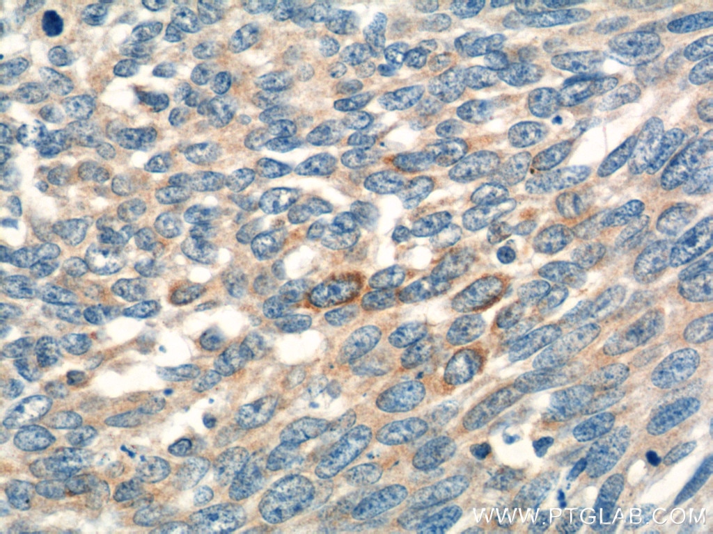 Immunohistochemistry (IHC) staining of human skin cancer tissue using MIA Polyclonal antibody (15734-1-AP)