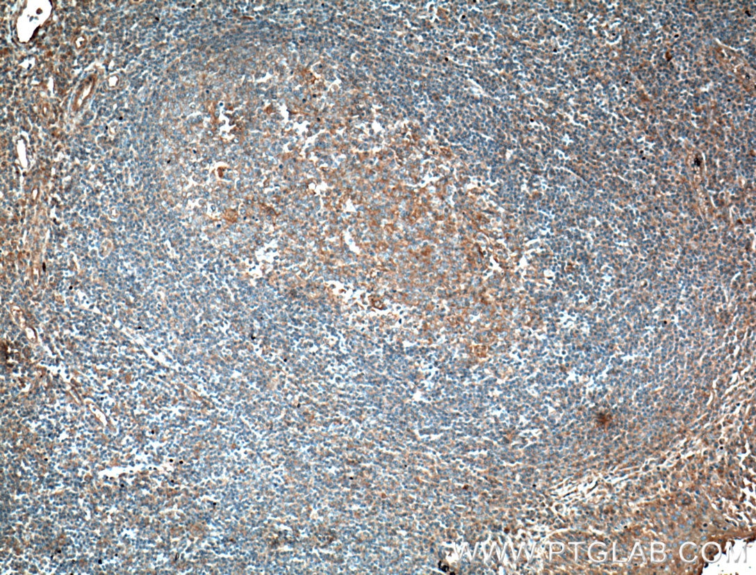 Immunohistochemistry (IHC) staining of human tonsillitis tissue using MICA Monoclonal antibody (66384-1-Ig)