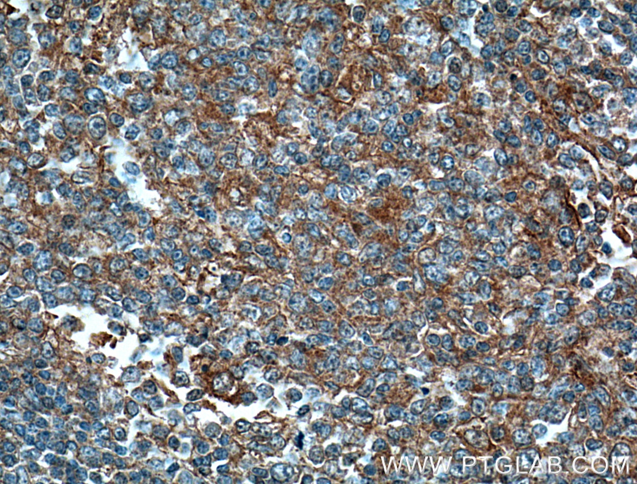 Immunohistochemistry (IHC) staining of human tonsillitis tissue using MICA Monoclonal antibody (66384-1-Ig)