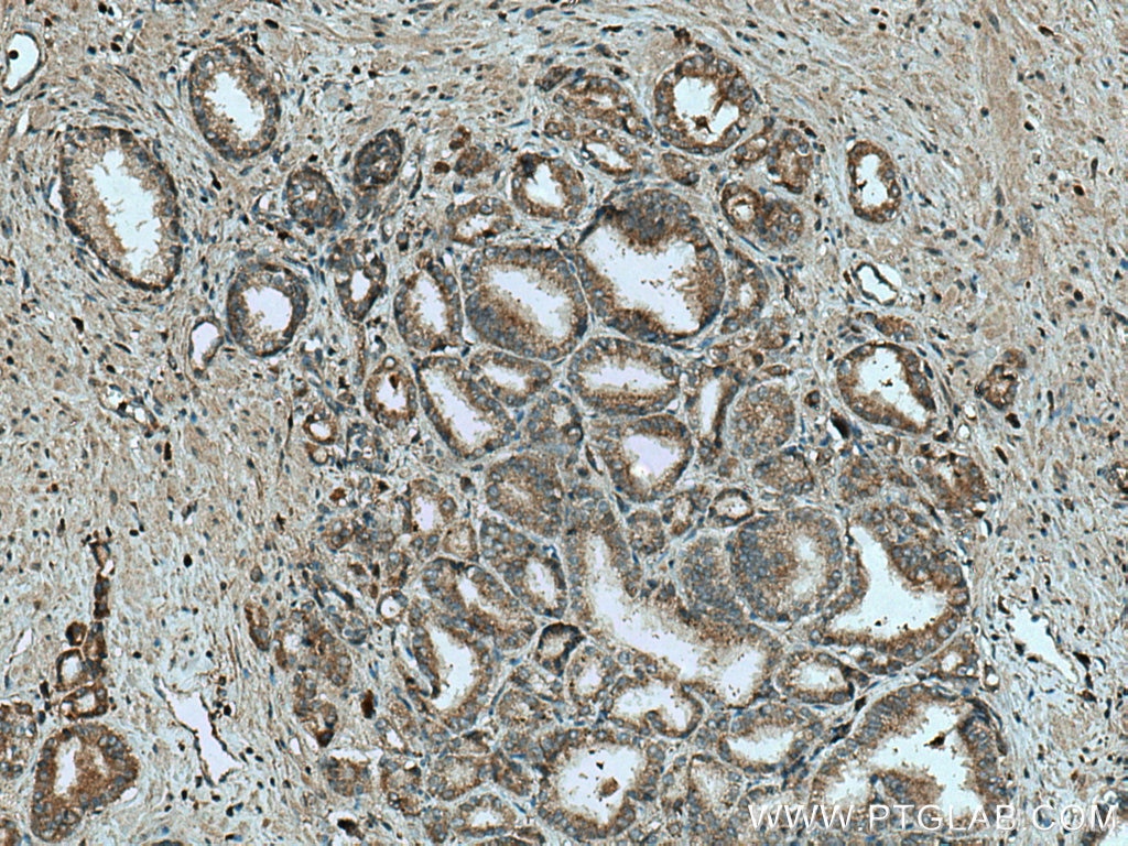 Immunohistochemistry (IHC) staining of human prostate cancer tissue using MICAL2 Polyclonal antibody (13965-1-AP)