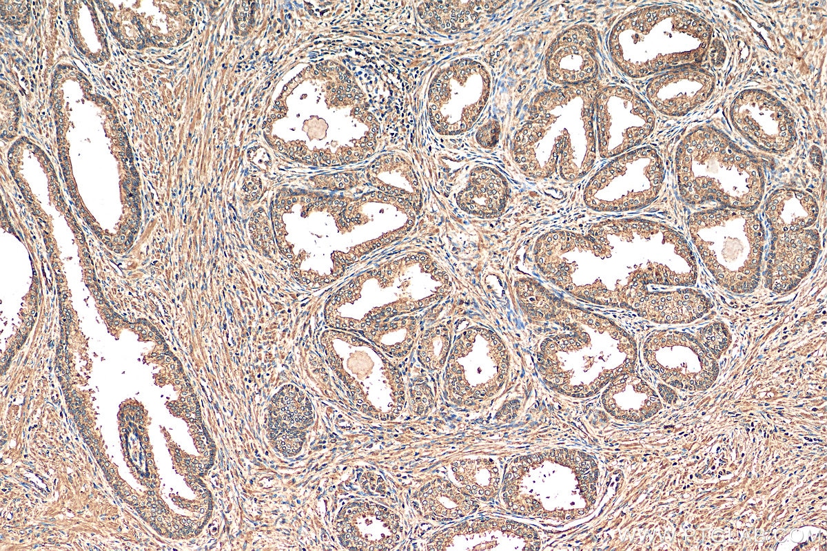 Immunohistochemistry (IHC) staining of human prostate cancer tissue using MICAL2 Polyclonal antibody (13965-1-AP)