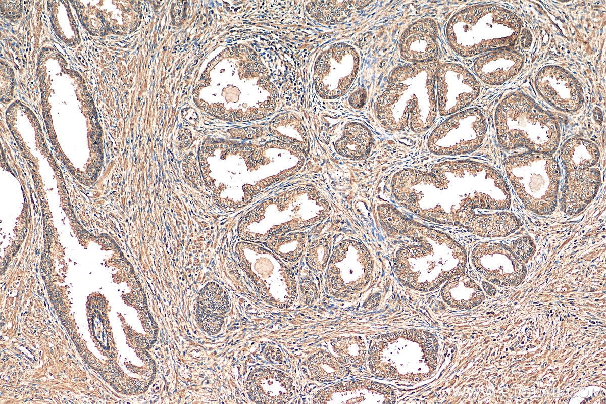 IHC staining of human prostate cancer using 13965-1-AP