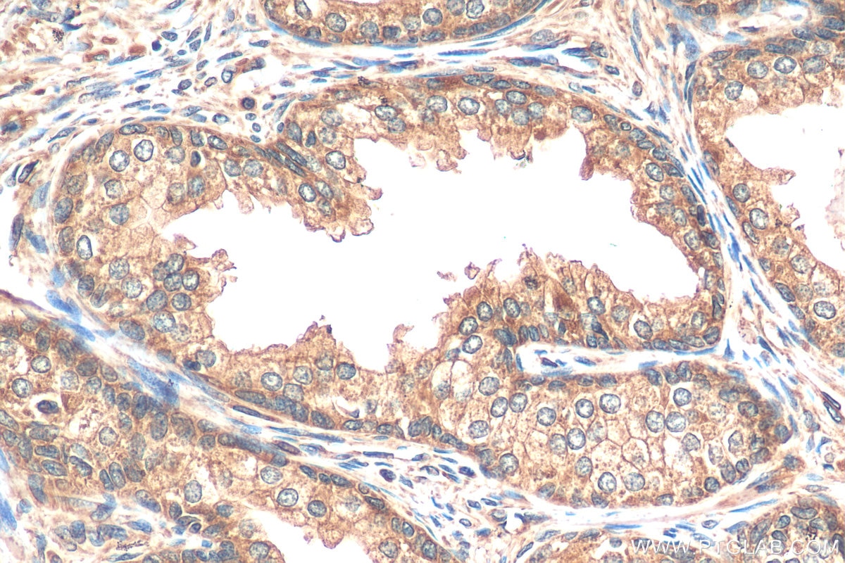 IHC staining of human prostate cancer using 13965-1-AP