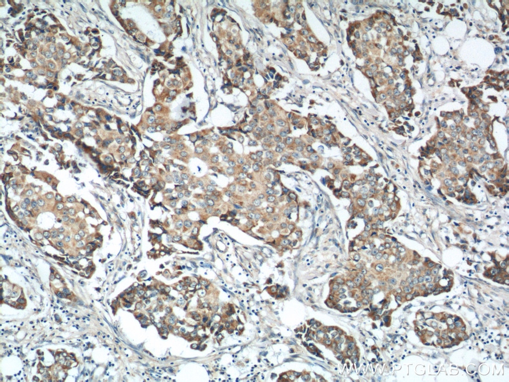 Immunohistochemistry (IHC) staining of human breast cancer tissue using MICB Polyclonal antibody (14325-1-AP)