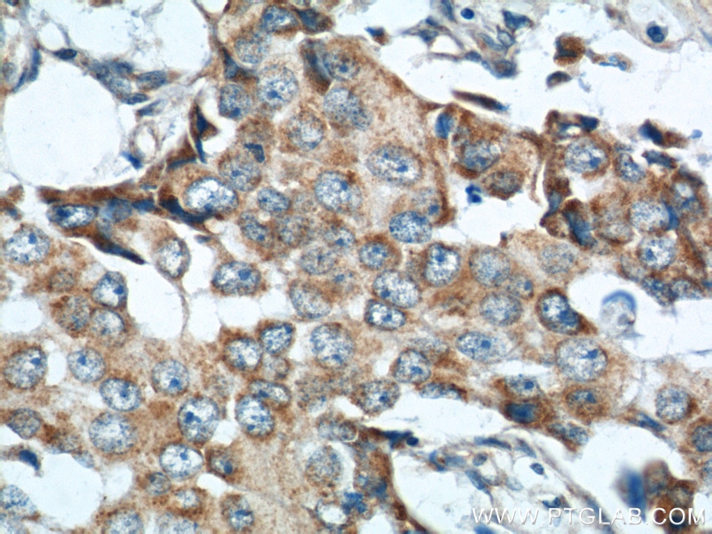 Immunohistochemistry (IHC) staining of human breast cancer tissue using MICB Polyclonal antibody (14325-1-AP)
